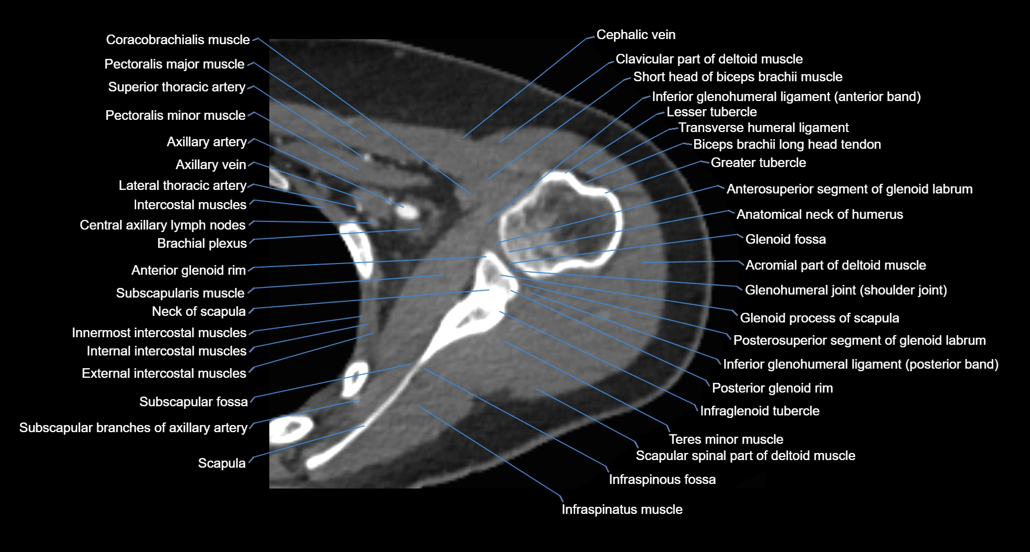 CT Shoulder axial cross sectional anatomy labelled radiology image -00038.webp